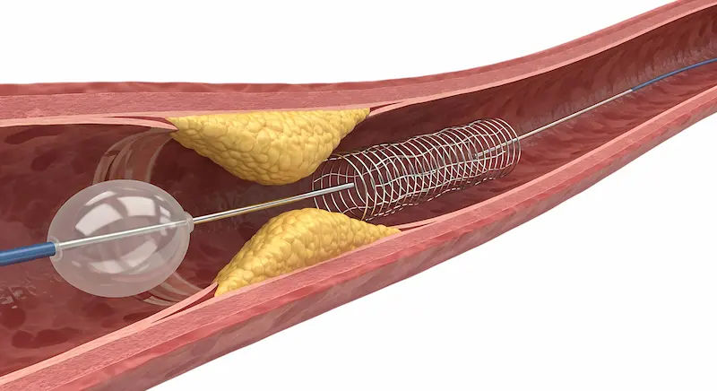 Is Balloon Angioplasty Permanent